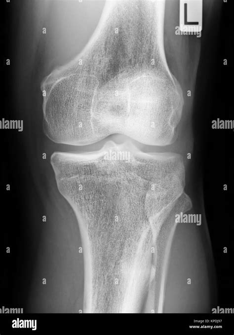 Ligamentos De La Rodilla Fotografías E Imágenes De Alta Resolución Alamy