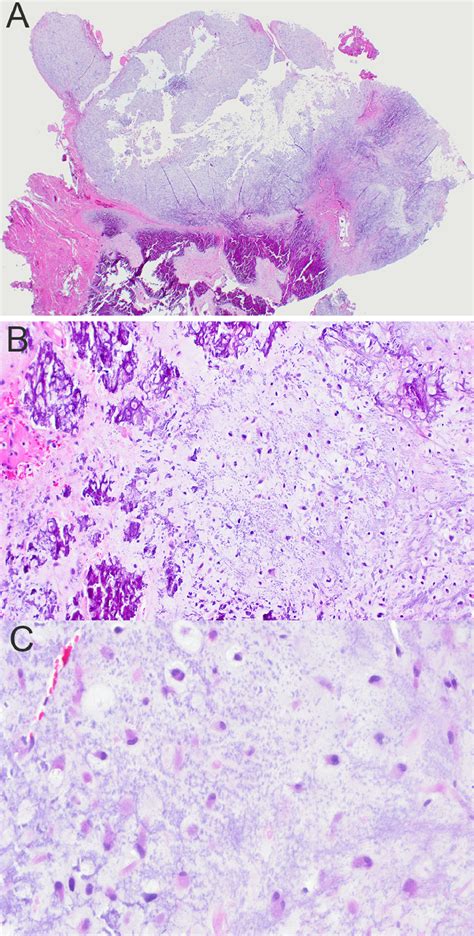 Calcified Chondroid Mesenchymal Neoplasm Report Of A Case Involving