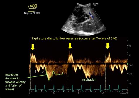 Pericardial Effusion Detected On Point Of Care Ultrasound What Next