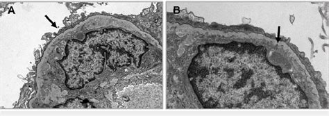 A Podocytes Display Moderate Foot Process Effacement Involving