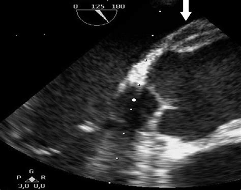 Preoperative Transesophageal Echocardiography Demonstrating A