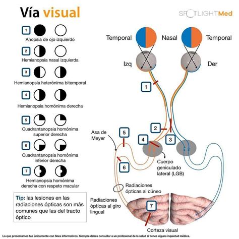 Alt. Vía visual. Anopsias | Estudiante de medicina, Cosas de enfermeria ...