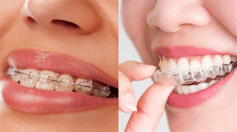 Invisalign Attachments Vs Traditional Braces