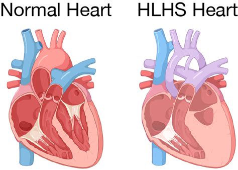 Hlhs Heart Defect Disount Deals Brunofuga Adv Br