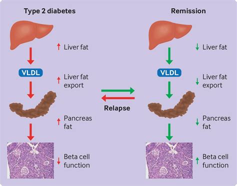 Nutritional Basis Of Type 2 Diabetes Remission The Bmj