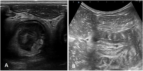 Ultrasound Shows Aspect Of Intestinal Intussusception As Succession Of