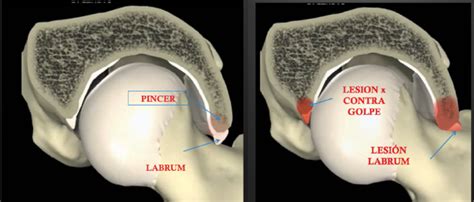 Mas All De La Terapia Manual Choque Femoroacetabular