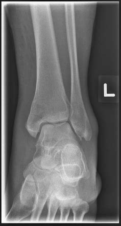 Talar Neck Fracture Radiology Case Radiopaedia Org