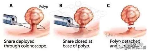 消化病学 90的肠癌一发现就是中晚期！如何才能早期发现？ 知乎