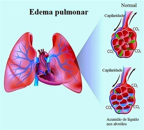 Edema Agudo De Pulmão Fisiopatologia Etiologia Diagnóstico E Tratamento ~ Fisionerds