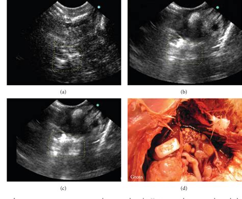 Ultrasound To Detect Ovarian Cancer