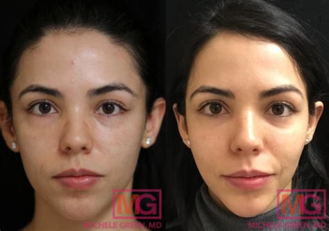 Microneedling Under Eyes Around Eyes And Eye Bags Dr Michele Green Md