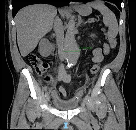 Frontal Ct Of The Abdomen And Pelvis Demonstrating 479 Cm Aaa