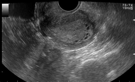 Endometrial Polyp Image Radiopaedia Org