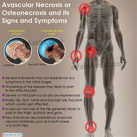 Avascular Necrosis Signs And Symptoms My Avn Is Atypical My Joints Are