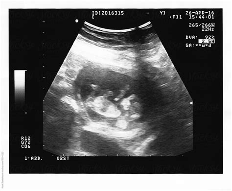 Week Ultrasound Pictures