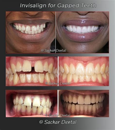 Dentist NYC Invisalign For Gapped Teeth Sachar Dental NYC