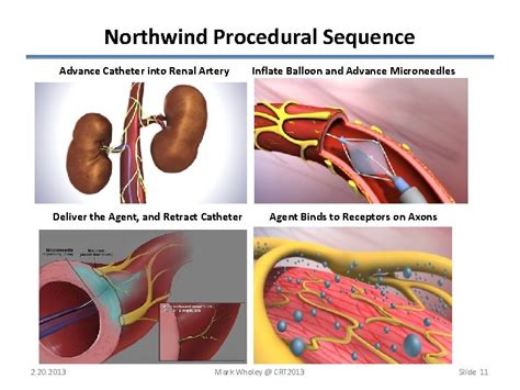 Next Generation Renal Denervation Devices Mark Wholey M