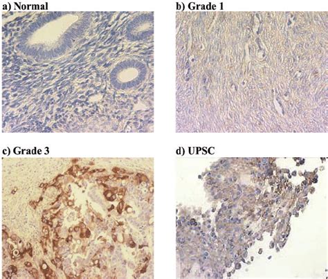 The Degree Of Upar Protein Expression Correlates With Histologic Grade