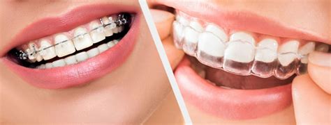 The Quickest Way To Straighten Your Teeth Silver Oaks Dental Clinic