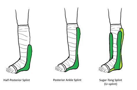 The Best Comprehensive Guide To Ankle Splints 2023 Durrell Clifford