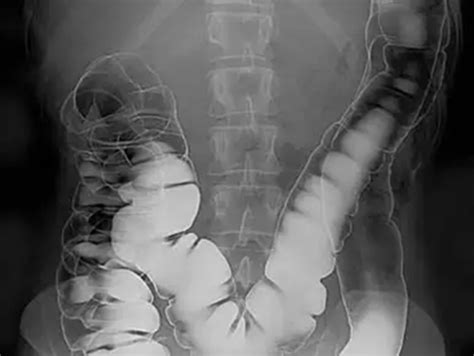 Intro To Radiographs Week 3 Flashcards Quizlet