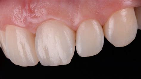 Esthetic And Functional Integration With Direct Composite Restorations