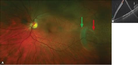 Retinoschisis Treatment Laser