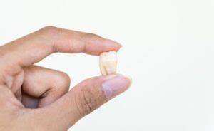 Broken Wisdom Tooth Causes Symptoms And Treatment Options