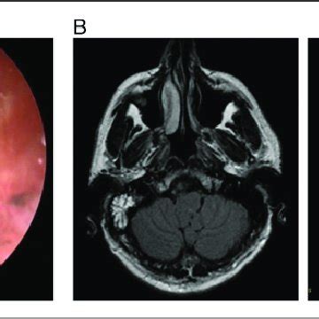 (A) Grommet is extruded to the ear canal and a fleshy, bleeding,... | Download Scientific Diagram