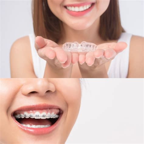 Metal Braces Versus Clear Aligners University General Dentists