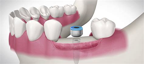 Implantes de carga inmediata para qué sirven SEDI