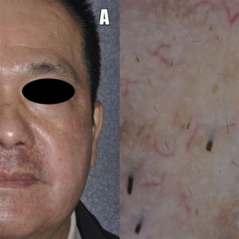 A Localized Monomorphous Erythematous Papules With Some Pustules Download Scientific Diagram