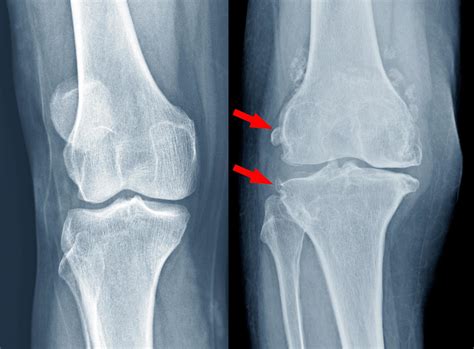 Osteoarthritis Knee Film X Ray 15763177 Stock Photo At Vecteezy