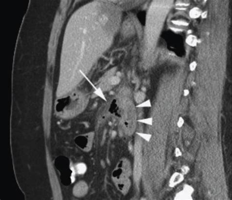 Retroperitoneally Perforating Duodenal Diverticulitis A Sagittal Ct