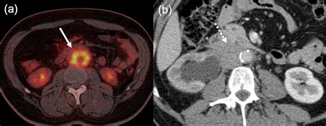 Imaging Manifestations Of Igg Related Disease Clinical Radiology