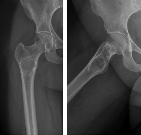 Liposclerosing Myxofibroma Of The Proximal Femur Diagnostic And