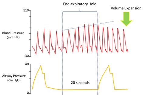 How End Expiratory Occlusion Test EEO Test Can Help Assess Fluid