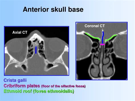 Ppt Anatomy And Relevant Anatomical Variants In Nasal And Paranasal