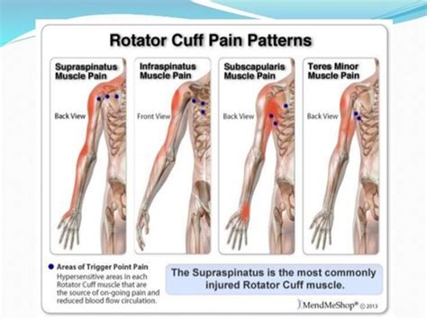 DXM III MSK Upper Extremity Flashcards Quizlet