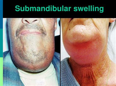 What Causes Submandibular Gland Swelling | Images and Photos finder