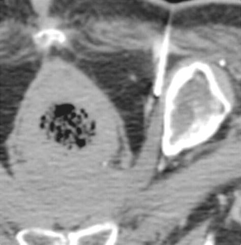 Pudendal Nerve Block Anesthesia Key