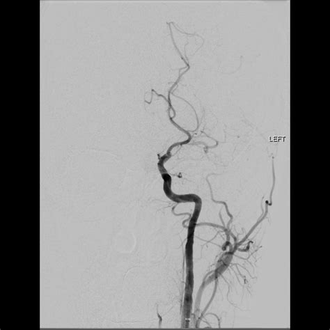 Left Mca And Ica Occlusion Endovascular Clot Retrieval Image