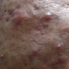 Zits, Acne, Pimples GROSS! - Gross Gallery | eBaum's World