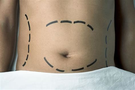 Liposuzione O Liposcultura Milano Chirurgia Plastica Dott G Basso