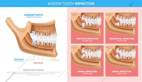 Wisdom Tooth Impaction Infographics With Anatomy Chart And Different Options Of Problem