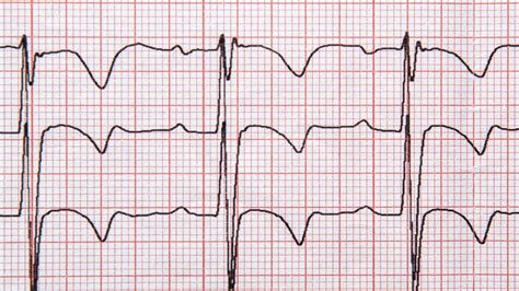 Arytmia Objawy Diagnoza I Leczenie Warszawa Ochota