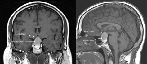 Pituitary Adenoma Ct Scan