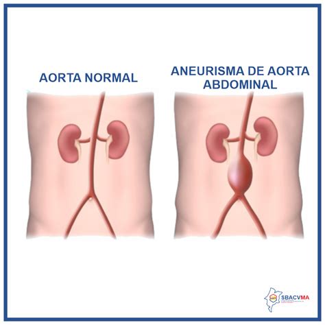 Aneurisma De Aorta Abdominal Sbacvma