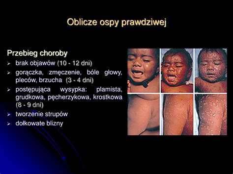 PPT Oblicze ospy prawdziwej ospa prawdziwa była wśród nas przez